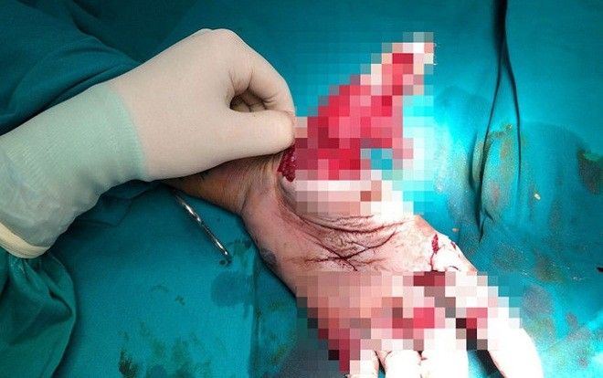 Chàng trai dập nát bàn tay vì nhậu say đốt pháo