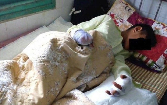 Nhiều vụ tai nạn do pháo trong dịp Tết Mậu Tuất 2018