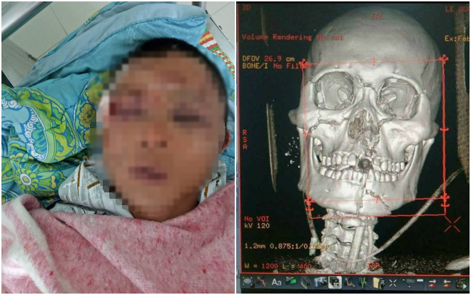 Người đàn ông nghi bắt cóc bé gái 14 tuổi bị đánh oan đến mức đa chấn thương rất nặng