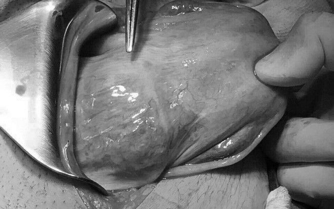 Thai lần 3 bám vào sẹo mổ cũ biến chứng, người phụ nữ 39 tuổi suýt chết