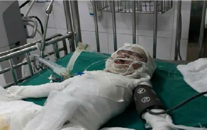 Bé gái 2 tuổi bị bỏng vôi đã qua đời