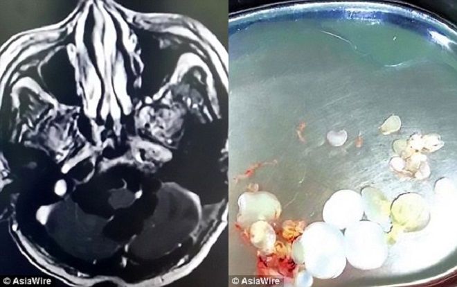 Kinh hãi phát hiện 30 quả trứng sán dây trong não người đàn ông từng ăn thịt sống