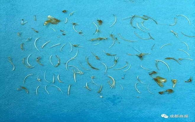 Kinh hoàng 100 chiếc xương cá mắc kẹt trong hậu môn