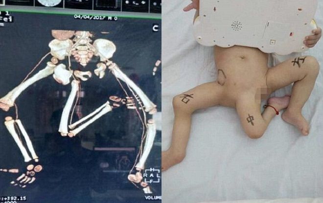 Kỳ lạ em bé có 3 chân tại Trung Quốc