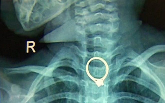 Mẹ tá hỏa phát hiện nhẫn kim cương chui vào họng con gái lúc nào không hay