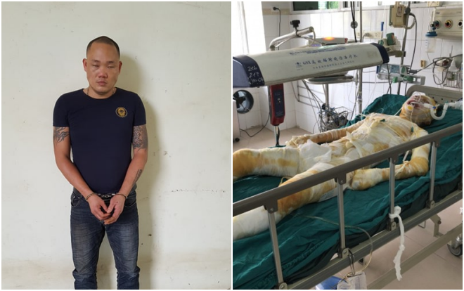 Bắt nghi phạm tẩm xăng đốt bạn gái vì ghen tuông
