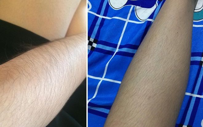 Lên mạng than thở 'lắm lông tay lông chân', cô gái không ngờ 'đồng bọn' lại nhiều đến vậy