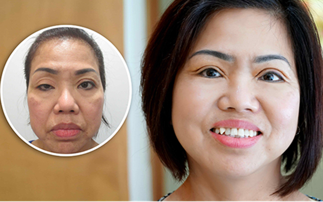 Nữ Việt kiều và câu chuyện tìm lại hy vọng cho đôi mắt sụp mí bẩm sinh