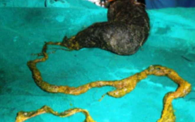 Bé gái 6 tuổi có búi tóc dài hơn 1m, nặng gần 3kg trong dạ dày