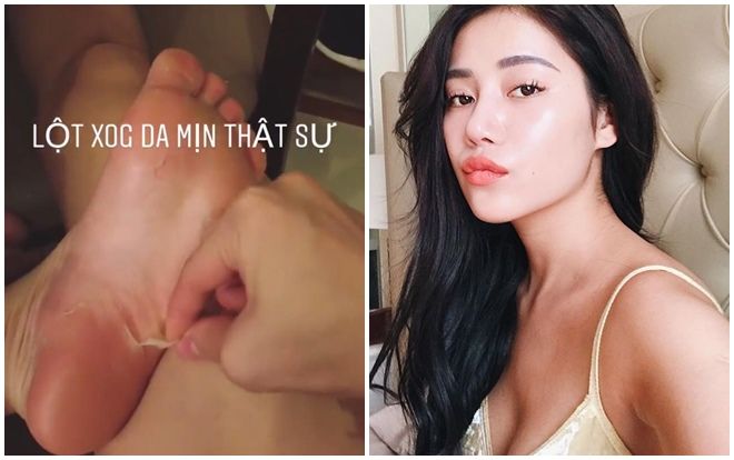 Hoảng hồn nhìn Milan Phạm lột da chân bằng phương pháp tẩy tế bào peeling