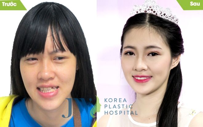 Bệnh viện thẩm mỹ JW mừng 30/4 - 1/5 miễn phí 100% phẫu thuật toàn diện