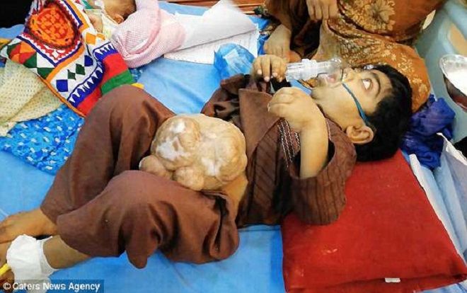 Bé trai 9 tuổi có rốn nặng tới 2kg