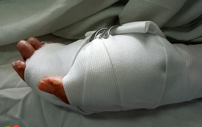 Côn đồ cầm hung khí xông vào quán game chém gần đứt lìa tay 1 phụ nữ