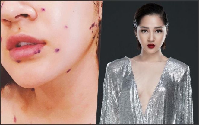 Bảo Anh huỷ hàng loạt show vì bệnh thuỷ đậu, sốt đến mất giọng