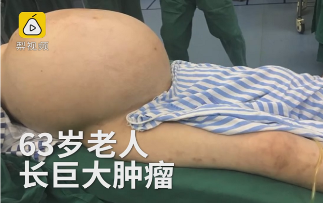 SỐC: Bệnh nhân 'sở hữu' khối u nặng gần 25 kg