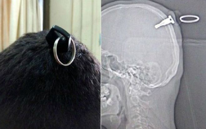 Hy hữu: Bị cắm thẳng chìa khóa vào đầu sâu 5 cm