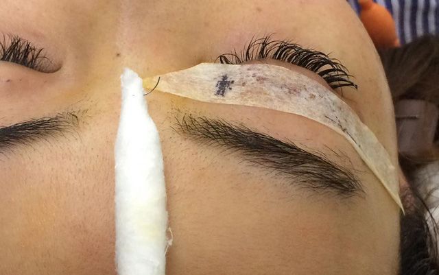 Tạo hình mí ở cơ sở thẩm mỹ, cô gái trẻ bất ngờ bị… lạc mất kim trong mắt