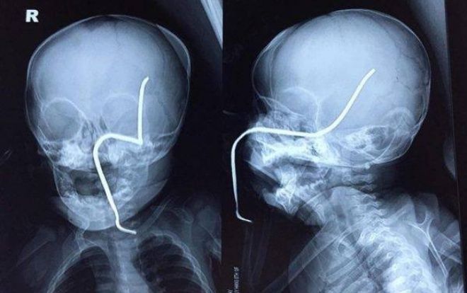 Đang chơi đùa, bé gái 8 tháng tuổi bị thanh sắt gỉ văng trúng xuyên má, thủng xương sọ