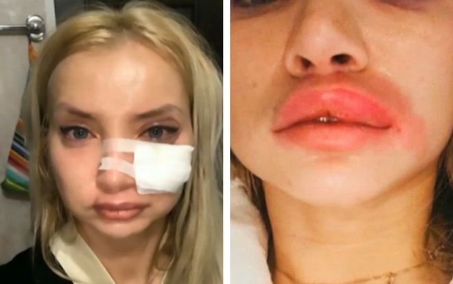 Filler có giúp “cải lão hoàn đồng” được không? Đừng đi tiêm trước khi đọc bài viết này