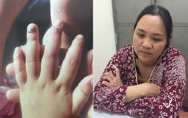 Bé gái 4 tuổi bị 'mẹ hờ' bạo hành đến mức cả người chi chít vết thương vì nghịch