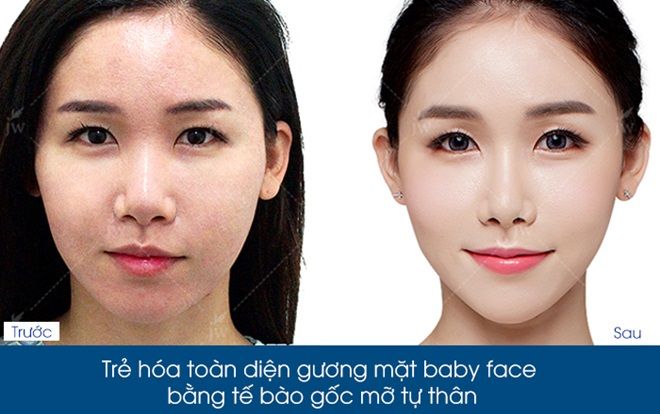 Cấy mỡ mặt Baby Fece đẹp ngay không cần chờ đợi