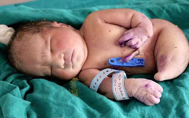 Bé sơ sinh mắc hội chứng 'nàng tiên cá' chào thế giới 15 phút thì qua đời