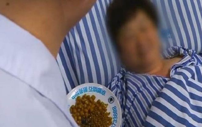 Nghiện đồ ăn dầu mỡ, người phụ nữ có 468 viên sỏi trong túi mật