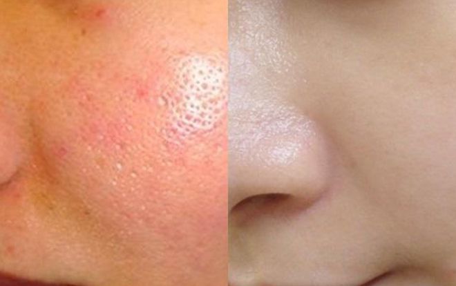 Thu nhỏ lỗ chân lông với 'khắc tinh' không đồng này