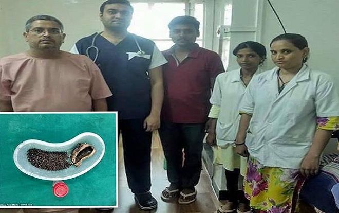 Người đàn ông 'bật ngửa' khi biết có 4.100 viên sỏi trong túi mật