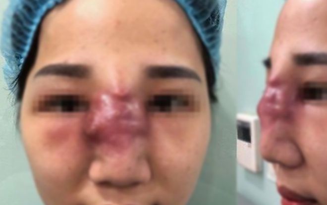 Cô gái trẻ đau đớn do mũi biến dạng, xuất hiện nhiều ổ mủ sau khi tiêm filler làm đẹp ở spa