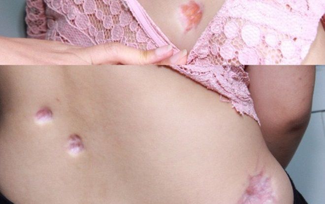 Bị sẹo lõm khắp người sau tiêm thuốc trị sẹo lồi ở thẩm mỹ viện