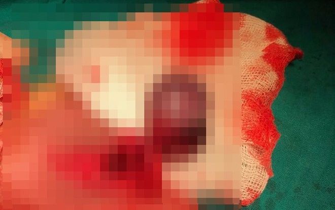 Ninh Thuận: Bé trai 9 tuổi bị hoại tử tinh hoàn phải cắt bỏ vì căn bệnh 'quái dị'