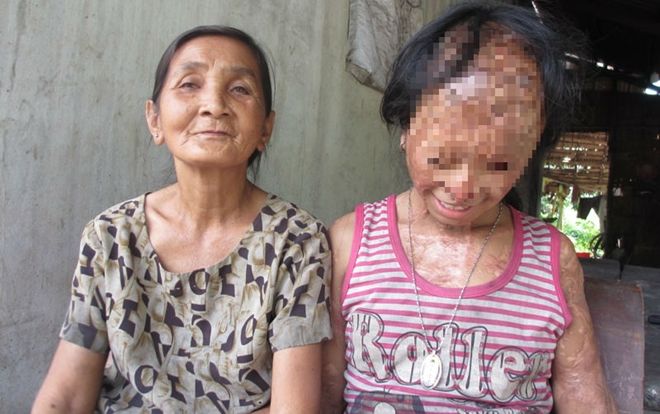 Nghẹn lòng ước mơ của bé gái bị tình địch của mẹ tạt a-xít mù hai mắt