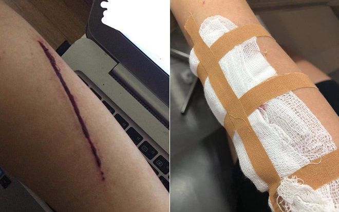 Xác minh thông tin thiếu nữ bị 2 thanh niên rạch tay cướp túi xách trong đêm