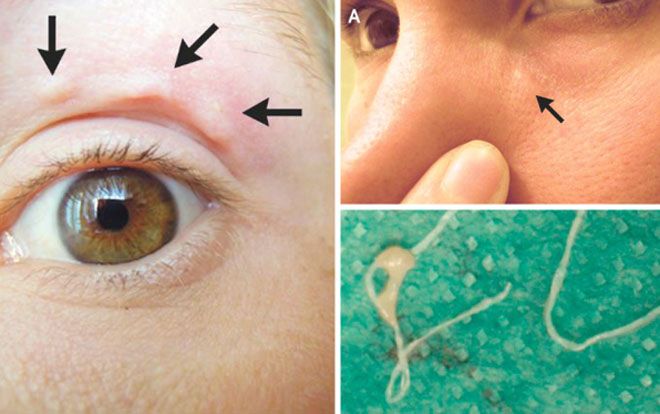 Sự thật rùng mình về 'khối u' biết di chuyển trên mặt người phụ nữ