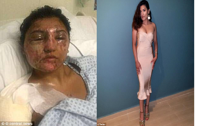 Sự phục hồi đáng kinh ngạc của cô gái bị tạt axit vào đúng ngày sinh nhật
