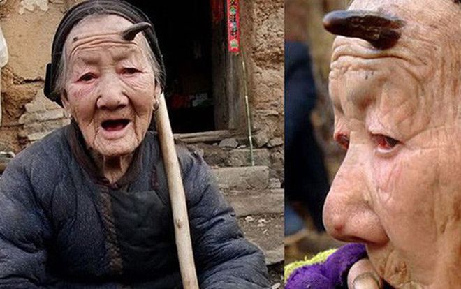 Căn bệnh lạ khiến con người mọc sừng y hệt như kỳ lân, các nhà khoa học ôm đầu không thể giải thích