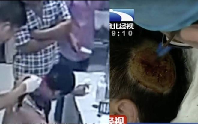 Sạc dự phòng phát nổ dưới gối, người đàn ông bị thương nghiêm trọng