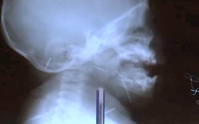 Tá hỏa phát hiện 10 cây kim trong cơ thể bé trai 9 tháng tuổi