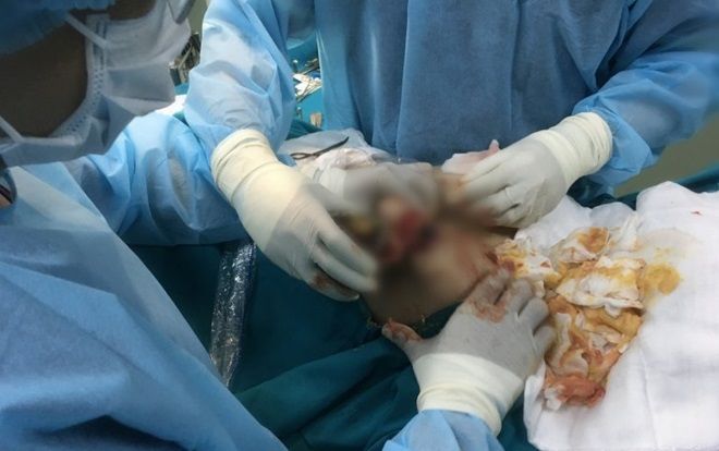 Phẫu thuật thẩm mỹ ở Thái Lan, nữ Việt kiều phải rút cả lít hóa chất lạ ở ngực