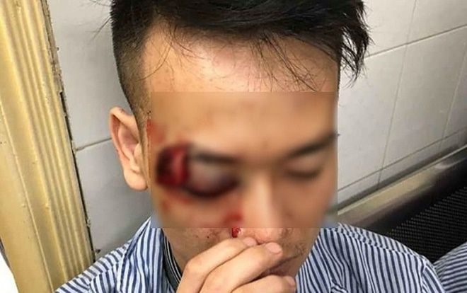Đi ăn đêm cùng nhóm bạn, một thanh niên bị đối tượng lạ mặt đâm mù mắt