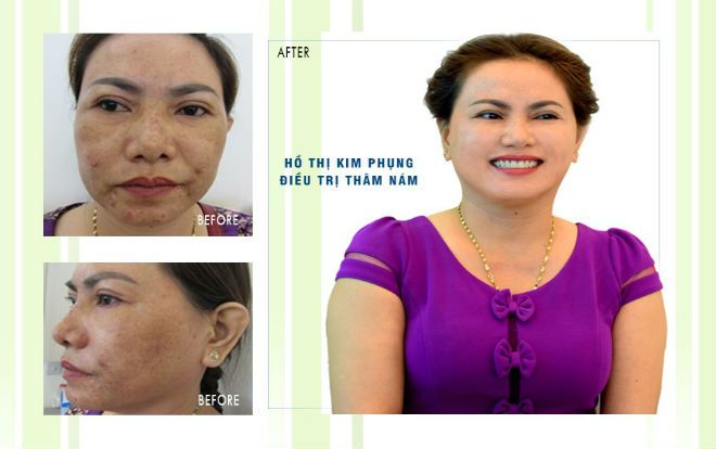 200 cơ hội trị mụn, nám miễn phí tại viện trẻ hóa và điều trị da chuyên sâu JW