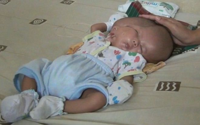 Nhói lòng bé trai sinh ra với hai khuôn mặt, hai bộ não trên cùng một cơ thể