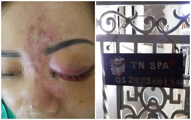 Tiêm filler nâng mũi ở spa không có giấy phép hoạt động, nữ khách hàng đau đớn vì bị mù mắt trái