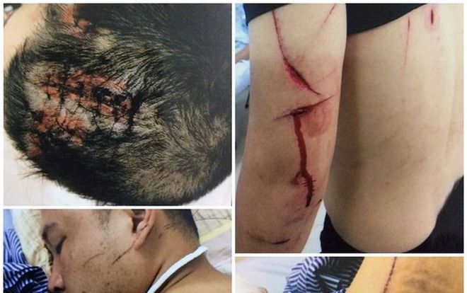 Hẹn ra quán cafe nói chuyện, 20 côn đồ vung dao kiếm chém người đàn ông trọng thương