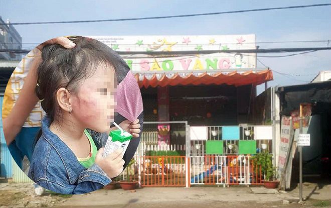 Bé gái 5 tuổi bị bảo mẫu tát mạnh nhiều cái gây nứt xương hàm