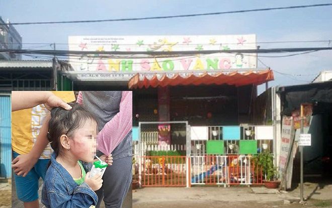 Vụ bé gái 5 tuổi bị bảo mẫu tát mạnh bầm tím mặt: Gia đình phủ nhận chuyện cháu bé bị nứt xương hàm