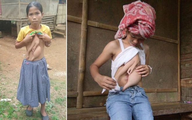 Bé gái 14 năm sống chung với 2 cánh tay thừa lủng lẳng trên ngực và bụng