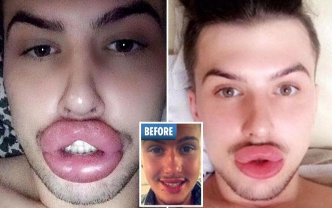 Chàng trai nghiện phẫu thuật thẩm mỹ, từng vỡ môi vì tiêm quá nhiều filler