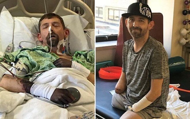 Đâm đơn kiện bệnh viện sau khi phải cắt cụt tứ chi vì nhiễm vi khuẩn ăn thịt người